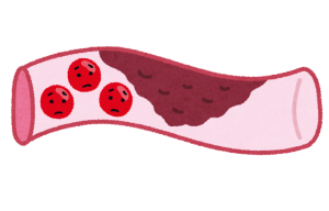 血管1